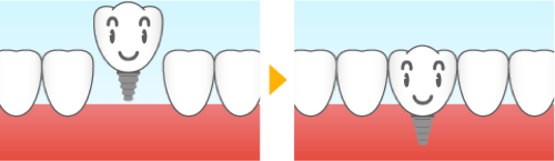 1本歯を失った場合のインプラント治療